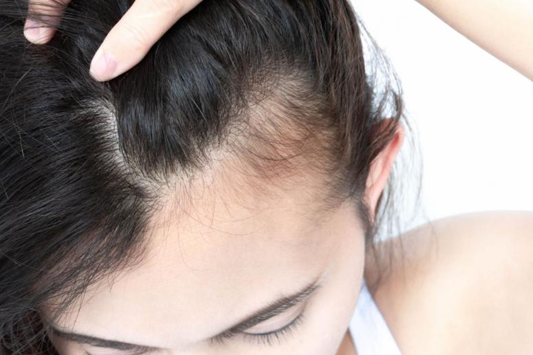 Experiencing Hair Loss After COVID-19 Experiencing Hair Loss After COVID-19