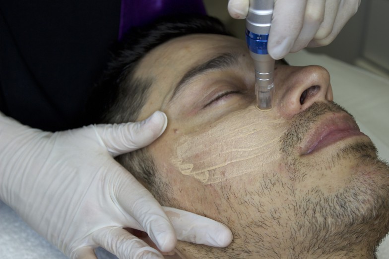 Microneedling
